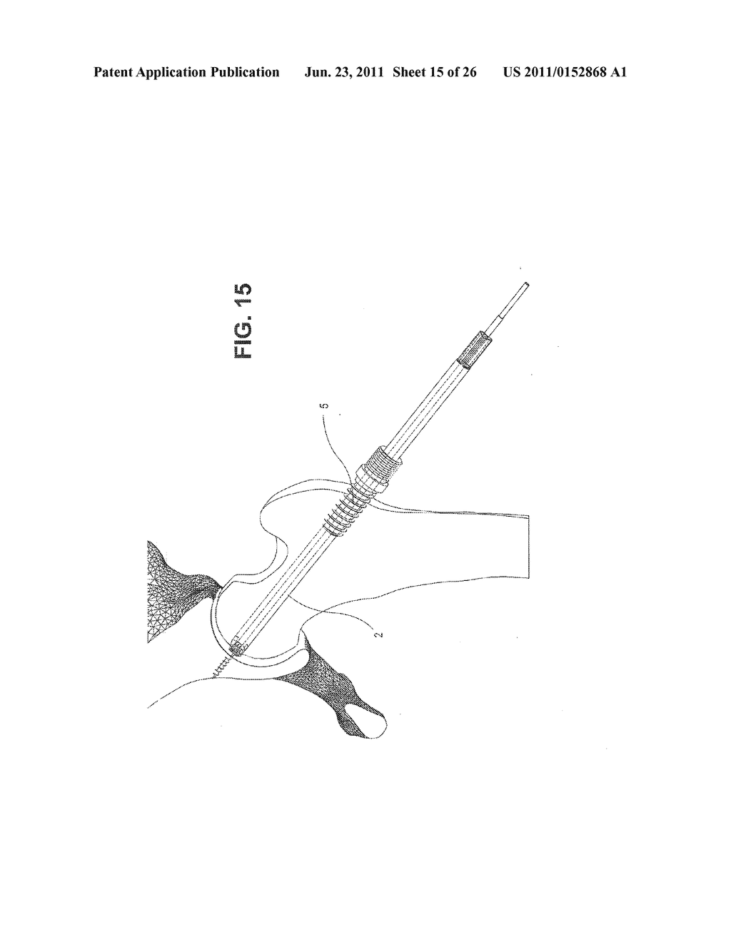 METHOD, DEVICE, AND SYSTEM FOR SHAVING AND SHAPING OF A JOINT - diagram, schematic, and image 16