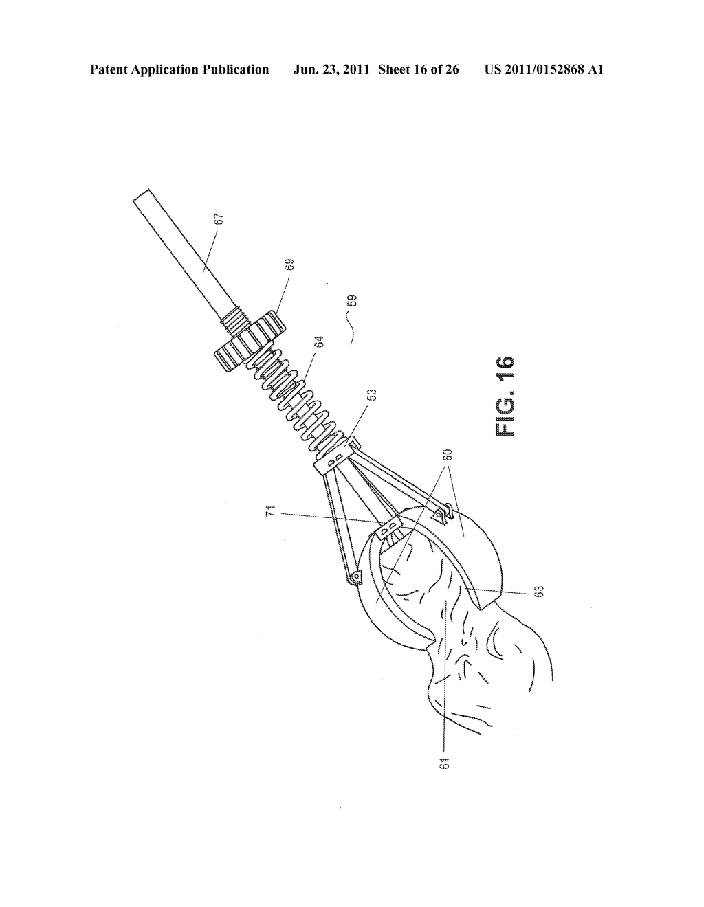 METHOD, DEVICE, AND SYSTEM FOR SHAVING AND SHAPING OF A JOINT - diagram, schematic, and image 17