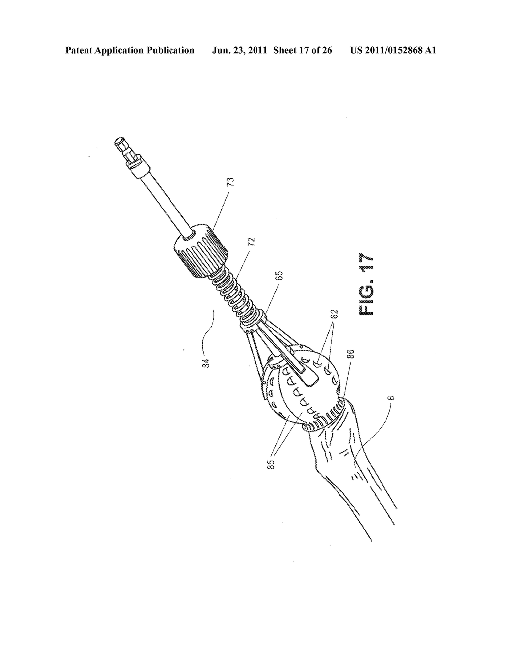 METHOD, DEVICE, AND SYSTEM FOR SHAVING AND SHAPING OF A JOINT - diagram, schematic, and image 18