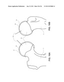 METHOD, DEVICE, AND SYSTEM FOR SHAVING AND SHAPING OF A JOINT diagram and image