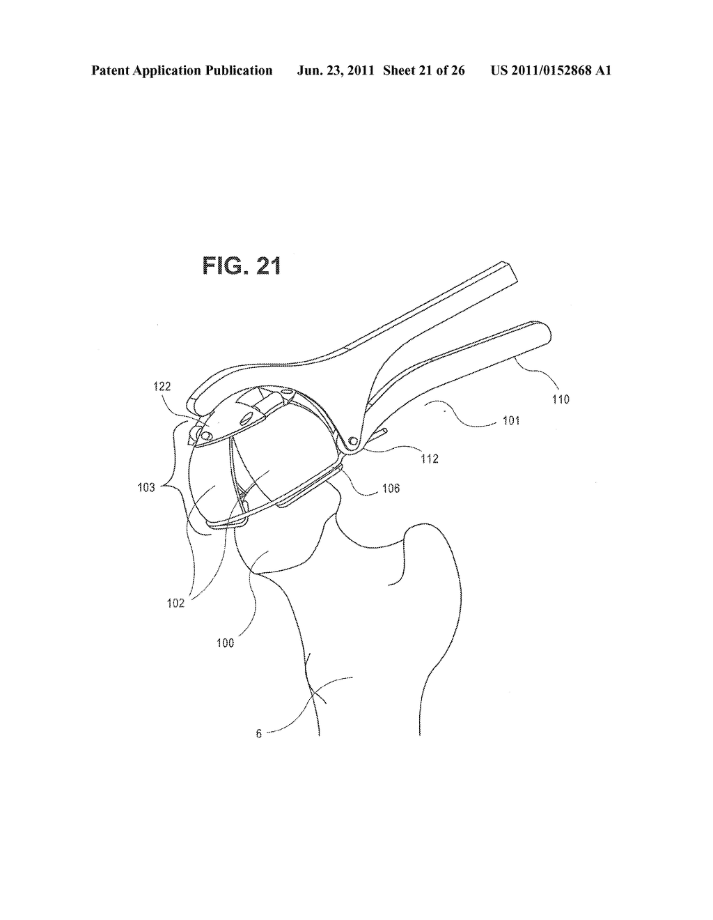 METHOD, DEVICE, AND SYSTEM FOR SHAVING AND SHAPING OF A JOINT - diagram, schematic, and image 22