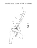 Bone Resurfacing System and Method diagram and image