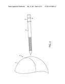 Bone Resurfacing System and Method diagram and image