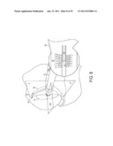 Bone Resurfacing System and Method diagram and image