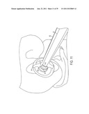 Bone Resurfacing System and Method diagram and image