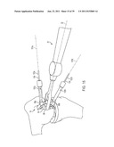 Bone Resurfacing System and Method diagram and image