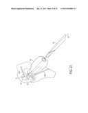 Bone Resurfacing System and Method diagram and image