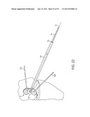 Bone Resurfacing System and Method diagram and image