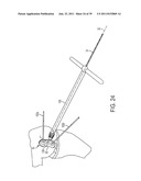 Bone Resurfacing System and Method diagram and image