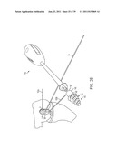 Bone Resurfacing System and Method diagram and image