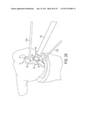 Bone Resurfacing System and Method diagram and image