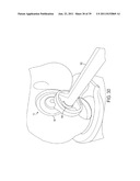 Bone Resurfacing System and Method diagram and image