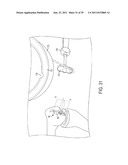 Bone Resurfacing System and Method diagram and image