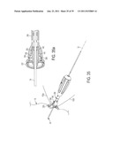 Bone Resurfacing System and Method diagram and image