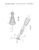 Bone Resurfacing System and Method diagram and image