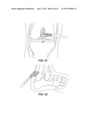 SUTURE PASSING INSTRUMENT AND METHOD diagram and image