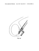 SUTURE PASSING INSTRUMENT AND METHOD diagram and image
