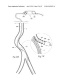 Devices, systems, and methods for performing atherectomy including     delivery of a bioactive material diagram and image