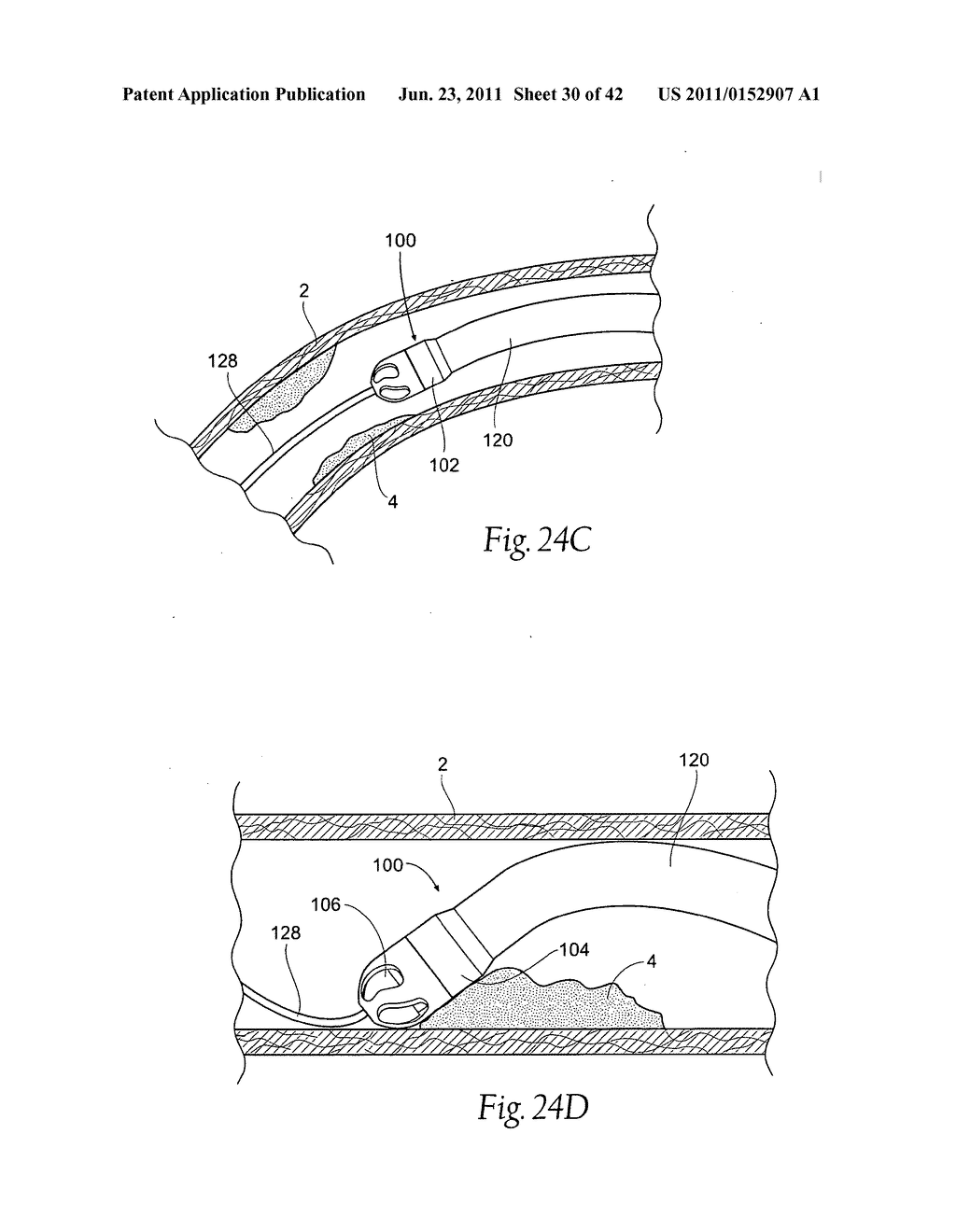 Devices, systems, and methods for performing atherectomy including     delivery of a bioactive material - diagram, schematic, and image 31
