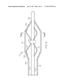 Catheter Having Internal Mechanisms to Encourage Balloon Re-folding diagram and image