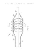 Catheter Having Internal Mechanisms to Encourage Balloon Re-folding diagram and image