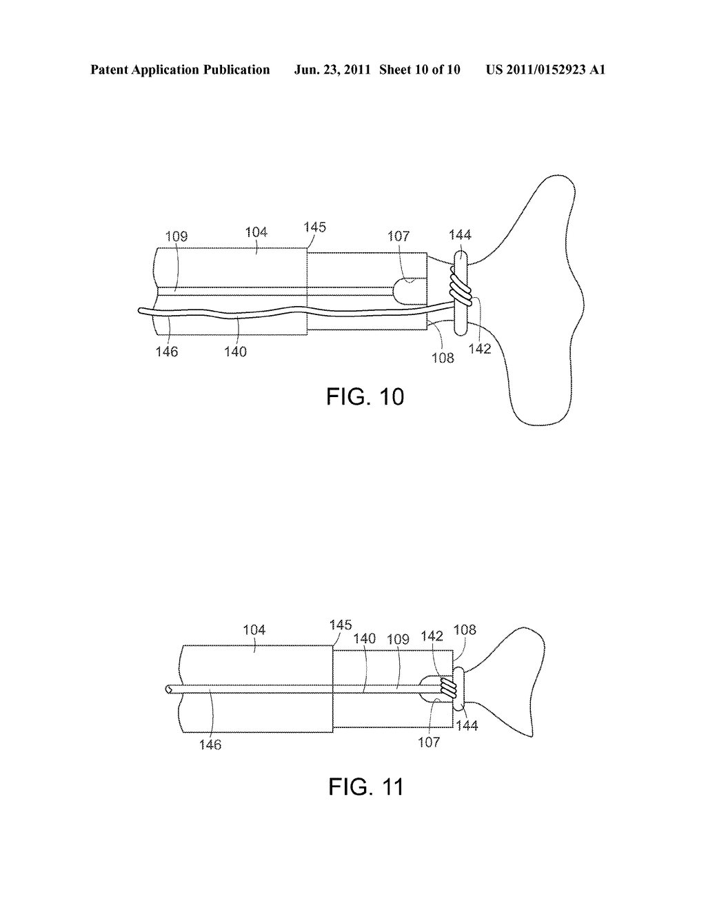 INCISION CLOSURE DEVICE - diagram, schematic, and image 11