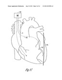 ELECTRICAL INIBITION OF THE PHRENIC NERVE DURING CARDIAC PACING diagram and image