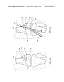 Method and Apparatus for Graft Fixation diagram and image