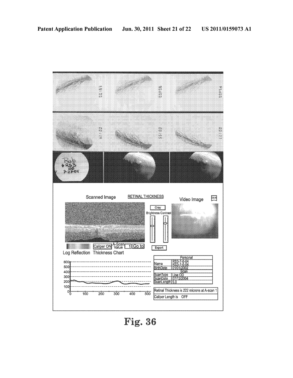 METHODS AND DEVICES FOR THE TREATMENT OF OCULAR CONDITIONS - diagram, schematic, and image 22