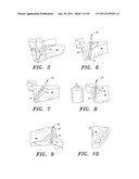 SURGICAL GUIDE AND METHOD diagram and image