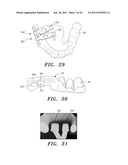 SURGICAL GUIDE AND METHOD diagram and image