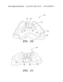 SURGICAL GUIDE AND METHOD diagram and image