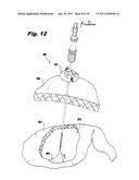 SURGICAL INSTRUMENTS FOR LAPAROSCOPIC ASPIRATION AND RETRACTION diagram and image