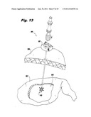 SURGICAL INSTRUMENTS FOR LAPAROSCOPIC ASPIRATION AND RETRACTION diagram and image