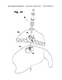 SURGICAL INSTRUMENTS FOR LAPAROSCOPIC ASPIRATION AND RETRACTION diagram and image