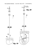 SURGICAL INSTRUMENTS FOR LAPAROSCOPIC ASPIRATION AND RETRACTION diagram and image