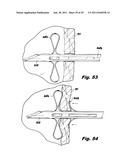 SURGICAL INSTRUMENTS FOR LAPAROSCOPIC ASPIRATION AND RETRACTION diagram and image