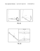 DISPOSABLE WAND AND SENSOR FOR ORTHOPEDIC ALIGNMENT diagram and image