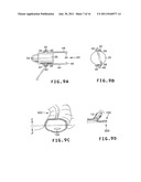 LIGHT MARKER FOR INDWELT USE IN PATIENTS BODY AND FOR IDENTIFICATION OF     LESIONS INSIDE PATIENTS TUBULAR ORGAN USING THE LIGHT MARKER diagram and image