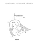 SYSTEM AND METHOD FOR DENATURING AND FIXING COLLAGENOUS TISSUE diagram and image