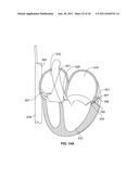 SYSTEM AND METHOD FOR DENATURING AND FIXING COLLAGENOUS TISSUE diagram and image