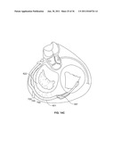 SYSTEM AND METHOD FOR DENATURING AND FIXING COLLAGENOUS TISSUE diagram and image