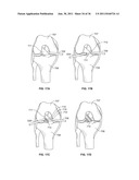 SYSTEM AND METHOD FOR DENATURING AND FIXING COLLAGENOUS TISSUE diagram and image