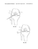 SYSTEM AND METHOD FOR DENATURING AND FIXING COLLAGENOUS TISSUE diagram and image