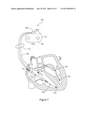 Modulation of AV Delay to Control Ventricular Interval Variability diagram and image