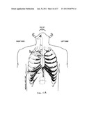 Obstructive Sleep Apnea Treatment Devices, Systems and Methods diagram and image