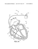 MRI CONDITIONALLY SAFE LEAD WITH LOW-PROFILE MULTI-LAYER CONDUCTOR FOR     LONGITUDINAL EXPANSION diagram and image