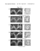 THERAPEUTIC AGENT AND DETECTION REAGENT FOR ARTERIOSCLEROTIC DISEASE WHICH     TARGETS FOR SALUSIN diagram and image