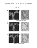 THERAPEUTIC AGENT AND DETECTION REAGENT FOR ARTERIOSCLEROTIC DISEASE WHICH     TARGETS FOR SALUSIN diagram and image