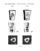 METHOD FOR TREATMENT OF BONE DISEASES AND FRACTURES diagram and image